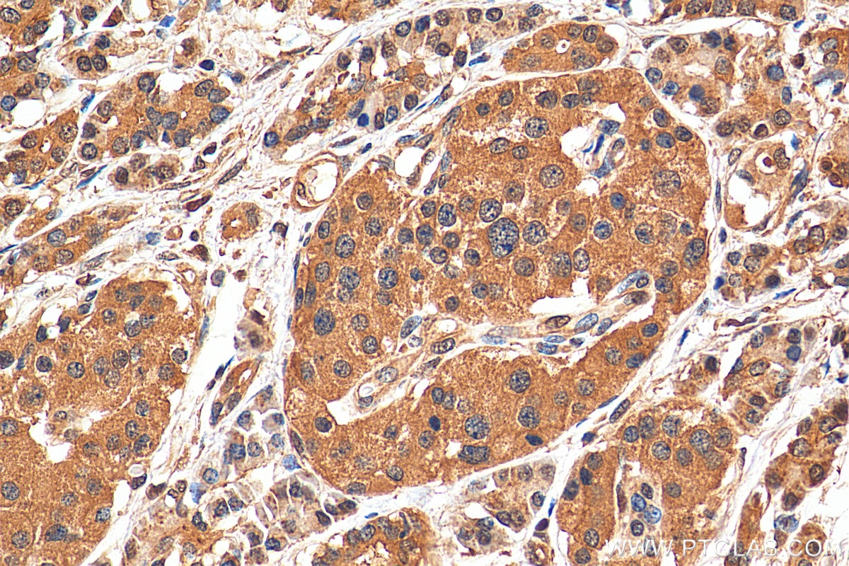 Immunohistochemistry (IHC) staining of human pancreas cancer tissue using ATF6 Polyclonal antibody (24169-1-AP)