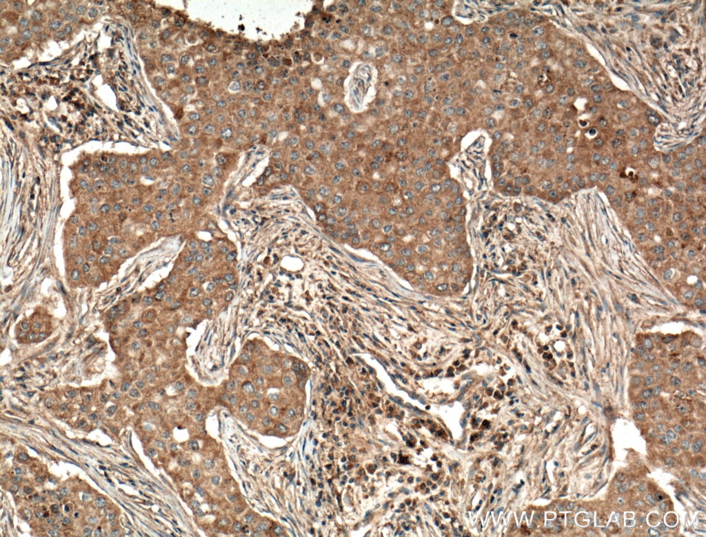 Immunohistochemistry (IHC) staining of human breast cancer tissue using ATF6 Monoclonal antibody (66563-1-Ig)