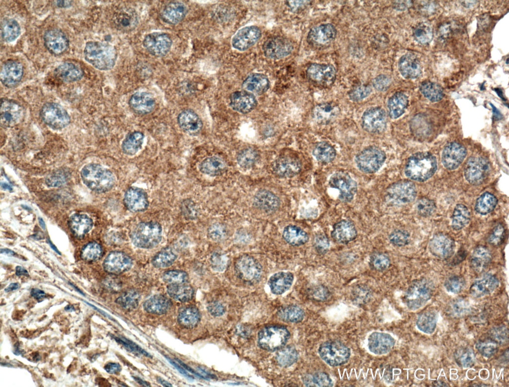 Immunohistochemistry (IHC) staining of human breast cancer tissue using ATF6 Monoclonal antibody (66563-1-Ig)