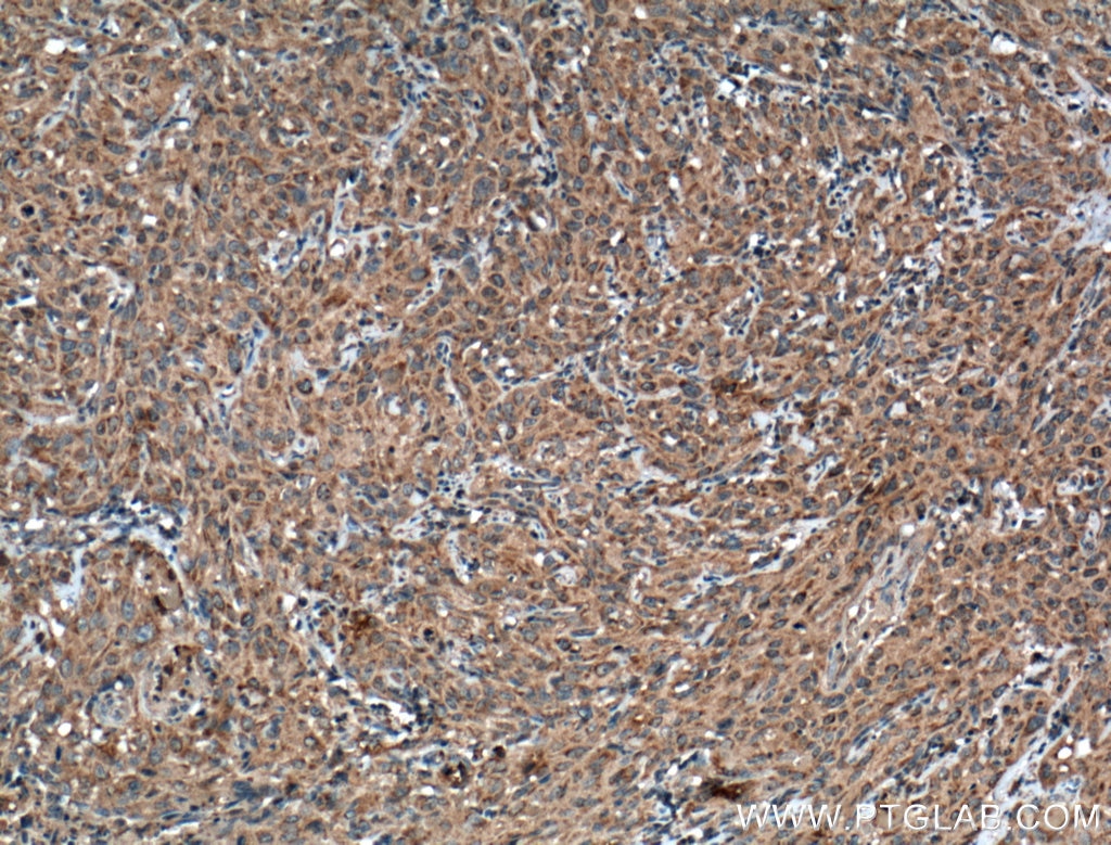 Immunohistochemistry (IHC) staining of human cervical cancer tissue using ATF6 Monoclonal antibody (66563-1-Ig)