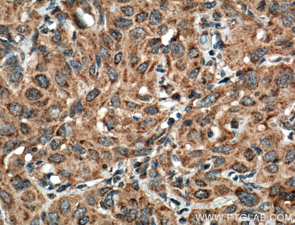 IHC staining of human cervical cancer using 66563-1-Ig