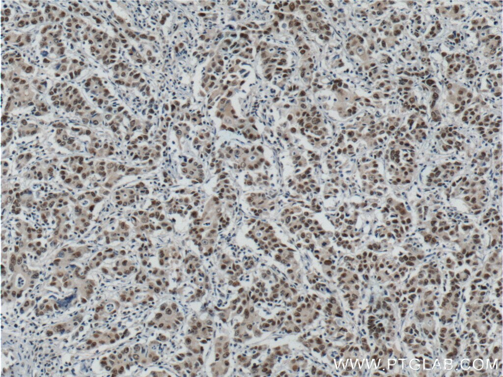 Immunohistochemistry (IHC) staining of human stomach cancer tissue using ATF7IP Polyclonal antibody (14699-1-AP)