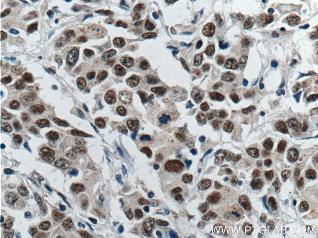 Immunohistochemistry (IHC) staining of human stomach cancer tissue using ATF7IP Polyclonal antibody (14699-1-AP)