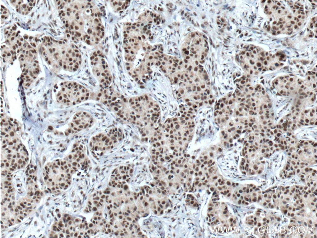 Immunohistochemistry (IHC) staining of human breast cancer tissue using ATF7IP Polyclonal antibody (14699-1-AP)