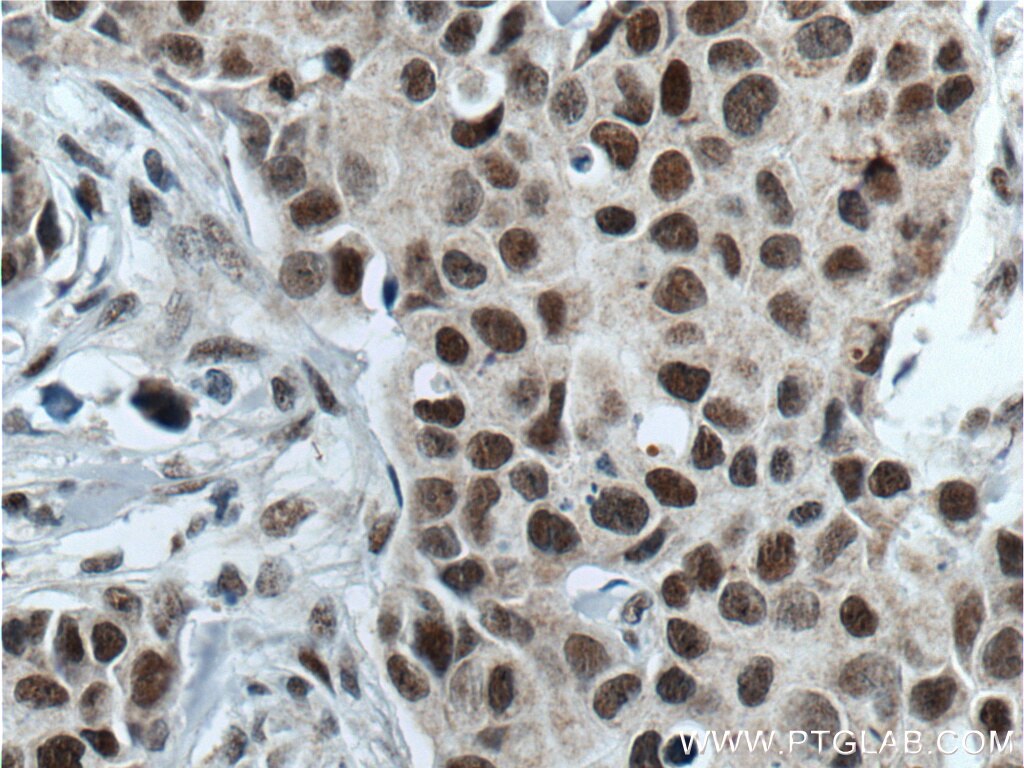 Immunohistochemistry (IHC) staining of human breast cancer tissue using ATF7IP Polyclonal antibody (14699-1-AP)