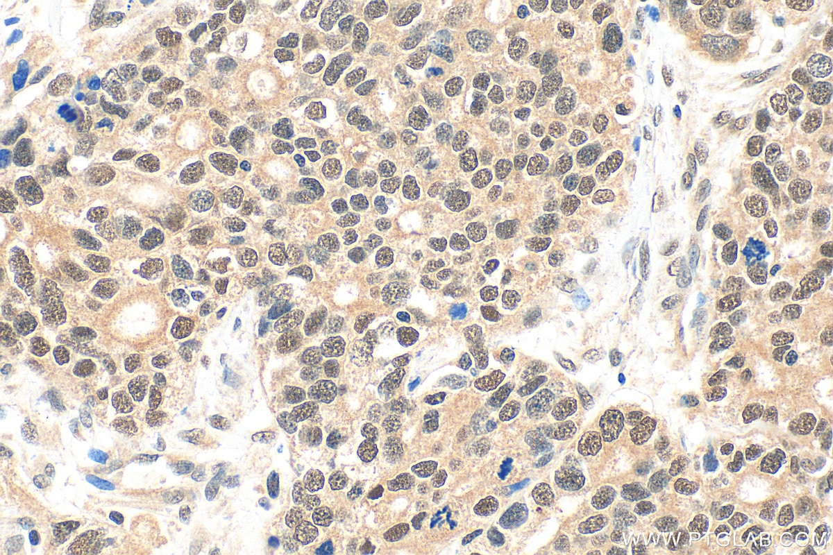 Immunohistochemistry (IHC) staining of human ovary tumor tissue using ATF7IP Polyclonal antibody (14699-1-AP)