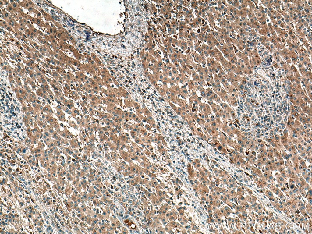 Immunohistochemistry (IHC) staining of human liver cancer tissue using ATG101 Polyclonal antibody (26562-1-AP)