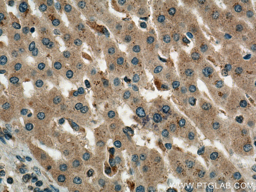 Immunohistochemistry (IHC) staining of human liver cancer tissue using ATG101 Polyclonal antibody (26562-1-AP)