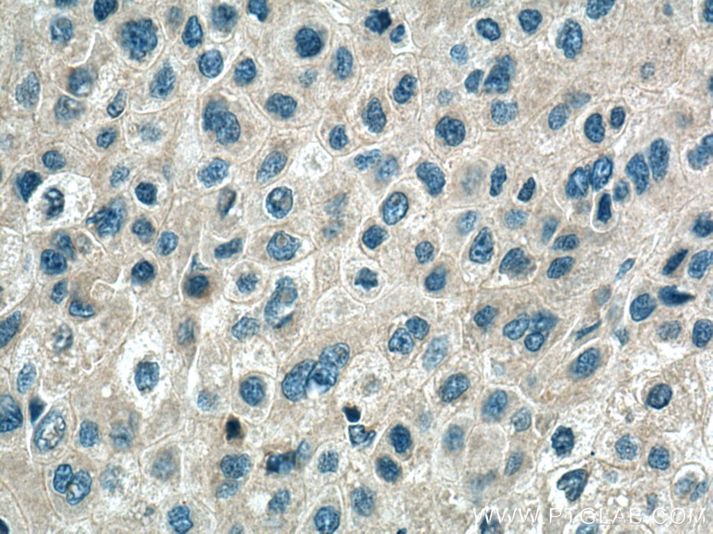 Immunohistochemistry (IHC) staining of human liver cancer tissue using ATG101 Polyclonal antibody (26562-1-AP)