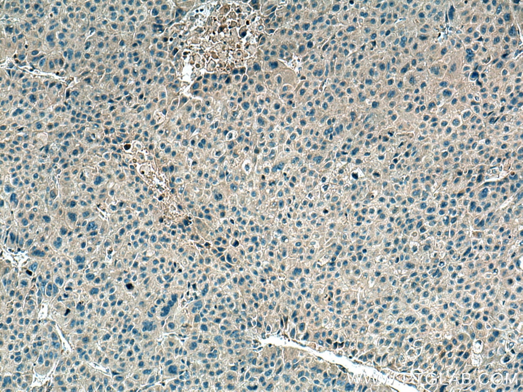 Immunohistochemistry (IHC) staining of human liver cancer tissue using ATG101 Polyclonal antibody (26562-1-AP)