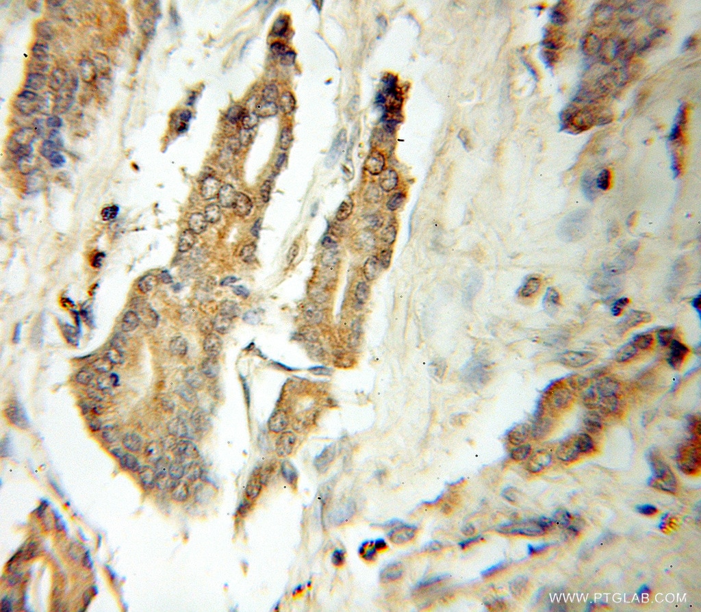 Immunohistochemistry (IHC) staining of human prostate cancer tissue using ATG12 Polyclonal antibody (11122-1-AP)