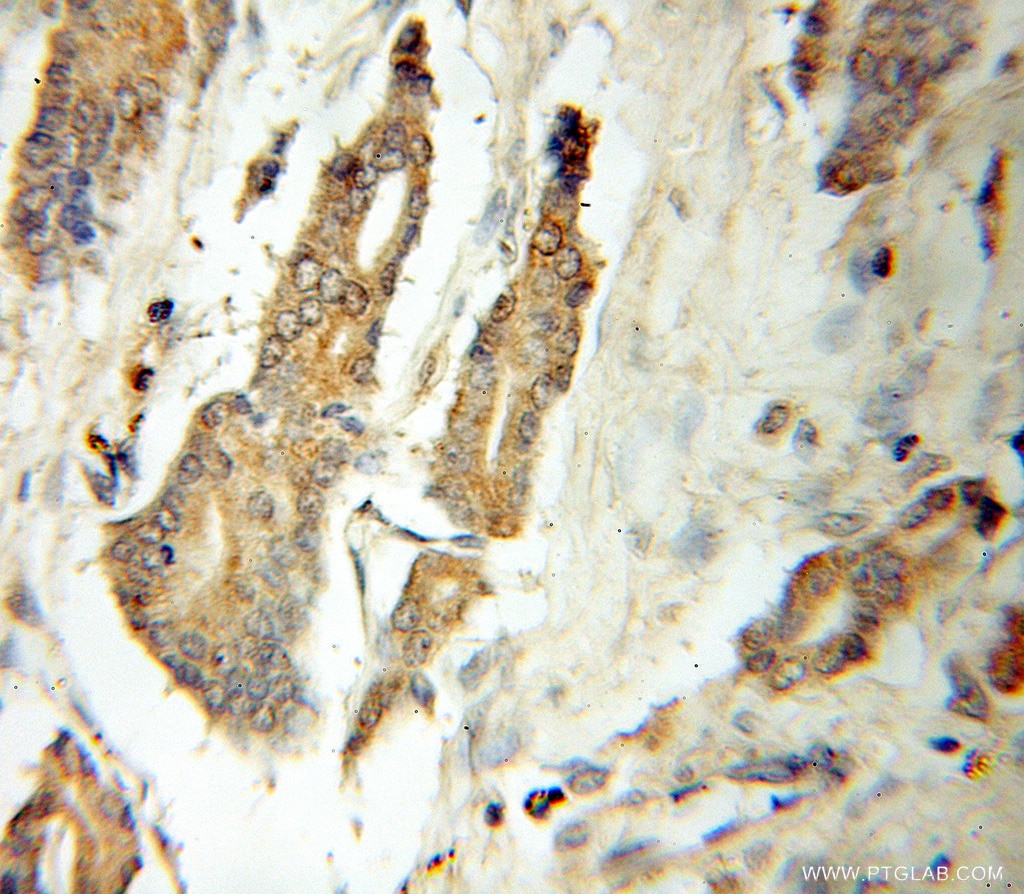 Immunohistochemistry (IHC) staining of human prostate cancer tissue using ATG12 Polyclonal antibody (11122-1-AP)