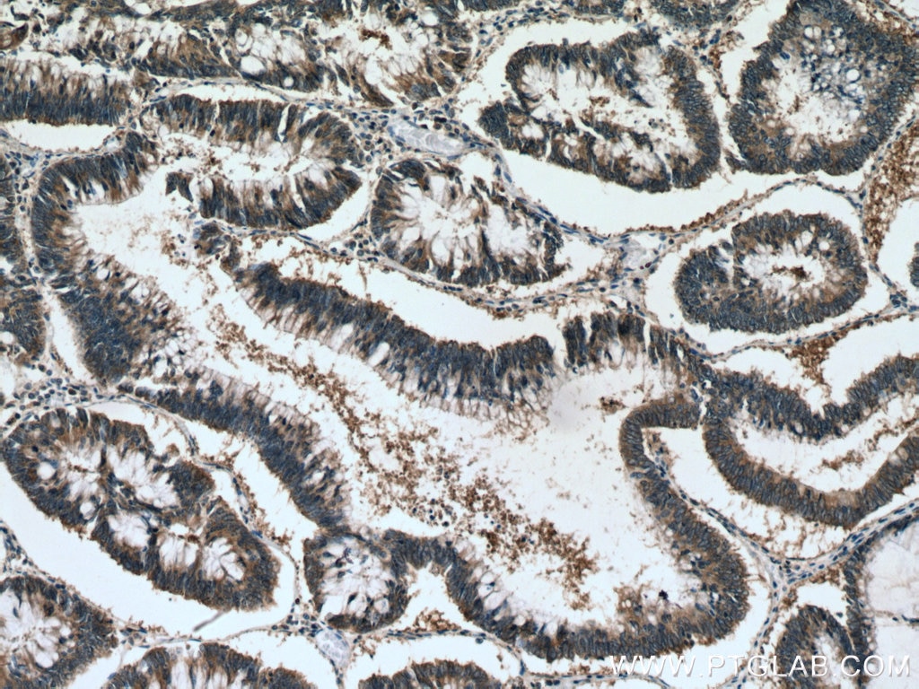 Immunohistochemistry (IHC) staining of human colon cancer tissue using ATG12 Polyclonal antibody (11264-1-AP)