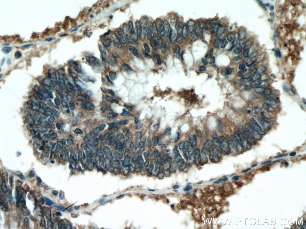 Immunohistochemistry (IHC) staining of human colon cancer tissue using ATG12 Polyclonal antibody (11264-1-AP)