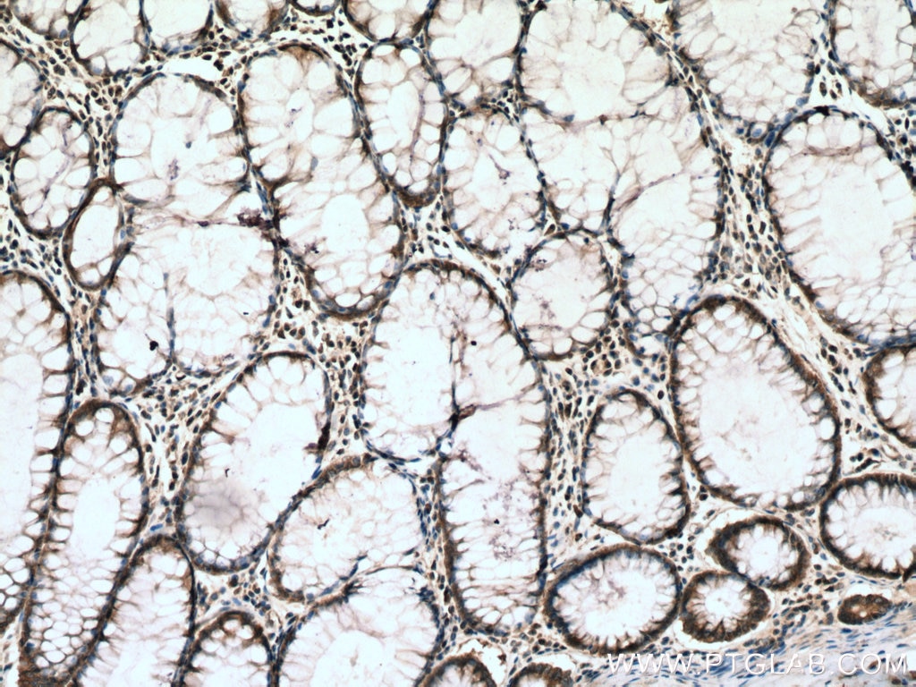 Immunohistochemistry (IHC) staining of human colon cancer tissue using ATG12 Polyclonal antibody (11264-1-AP)