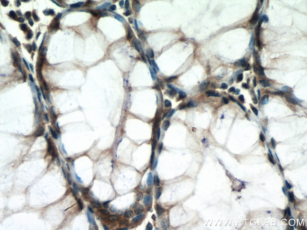 Immunohistochemistry (IHC) staining of human colon cancer tissue using ATG12 Polyclonal antibody (11264-1-AP)