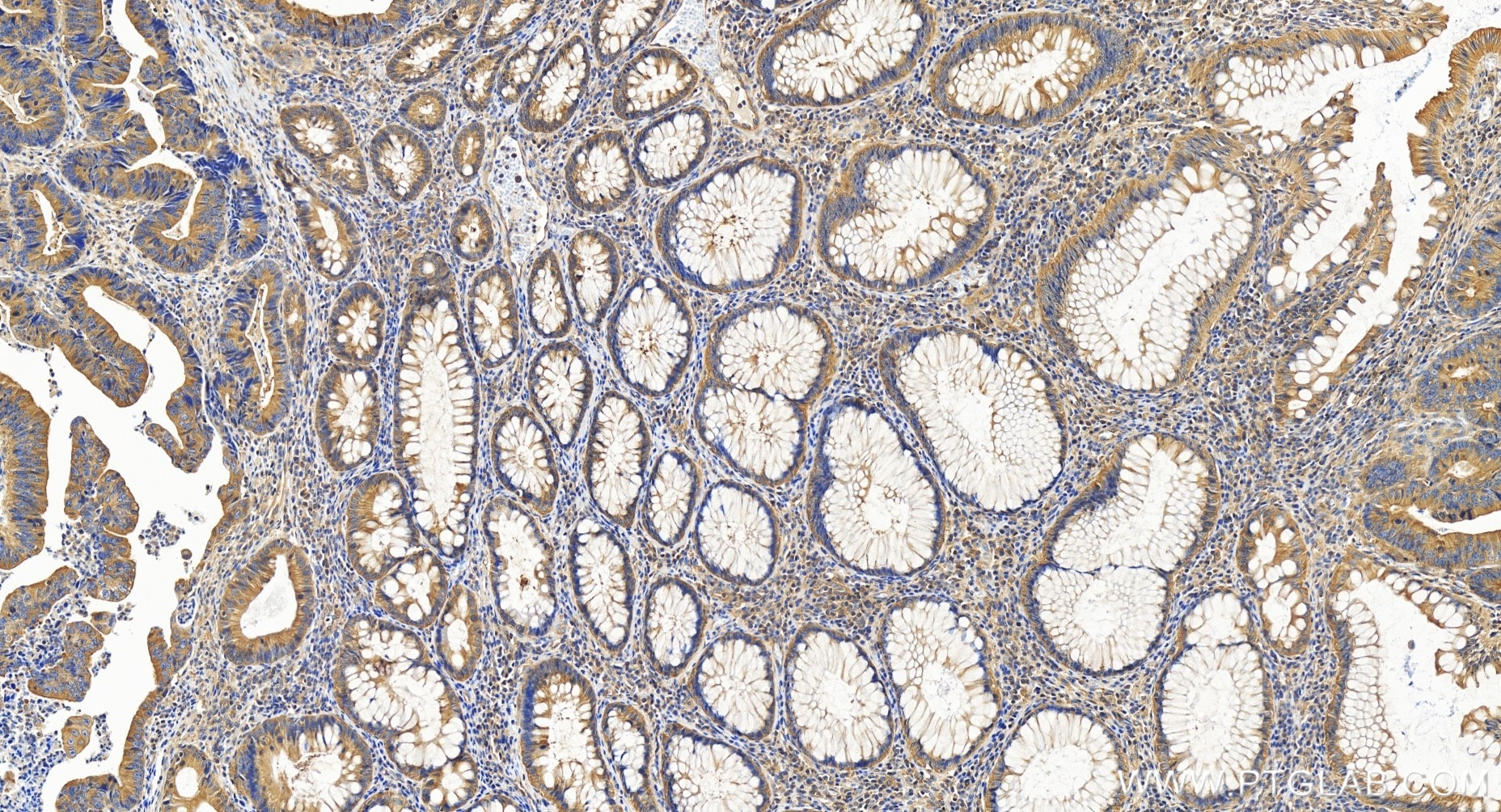 Immunohistochemistry (IHC) staining of human colon cancer tissue using ATG12 Recombinant antibody (84935-6-RR)