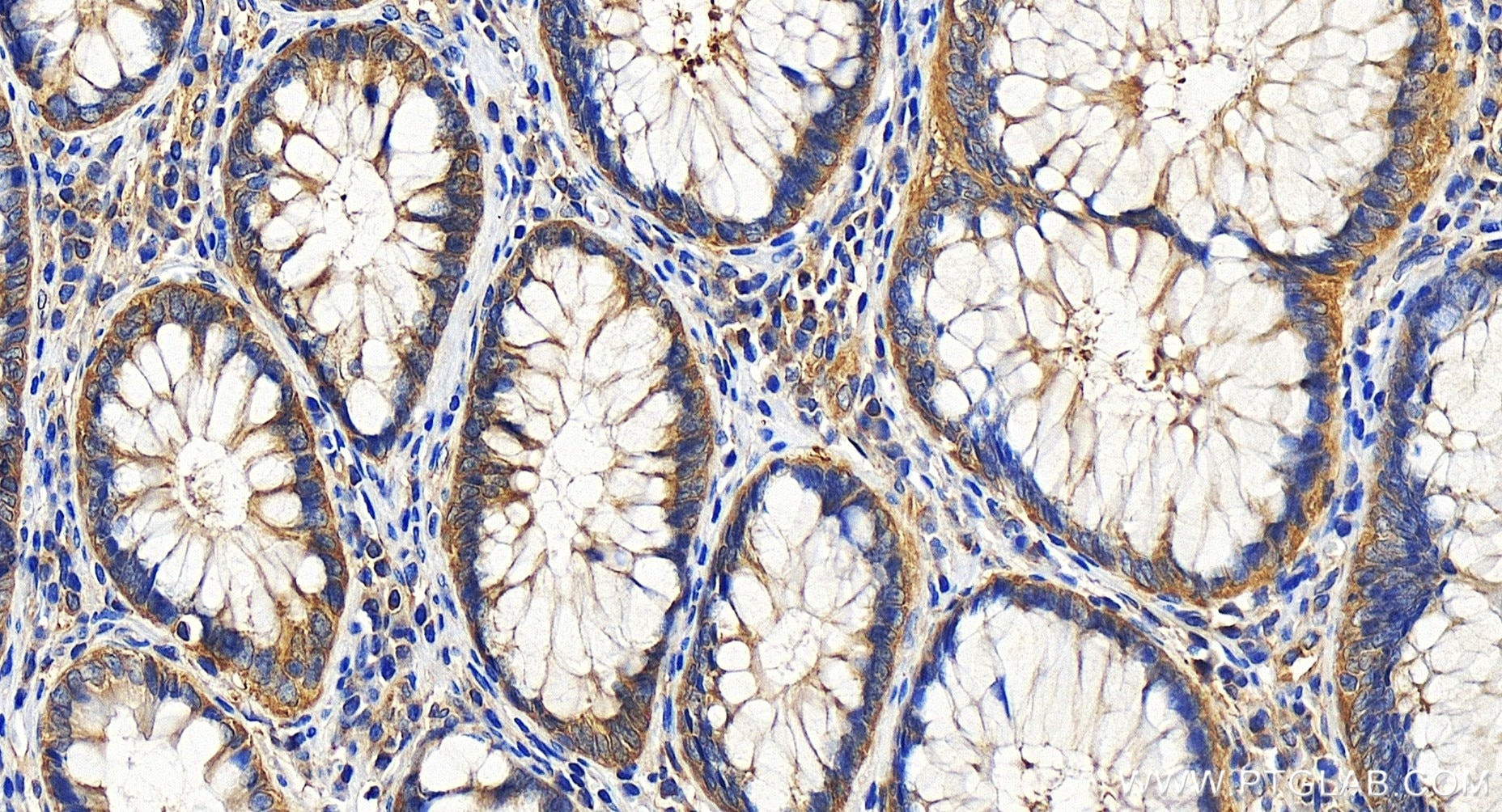 Immunohistochemistry (IHC) staining of human colon cancer tissue using ATG12 Recombinant antibody (84935-6-RR)