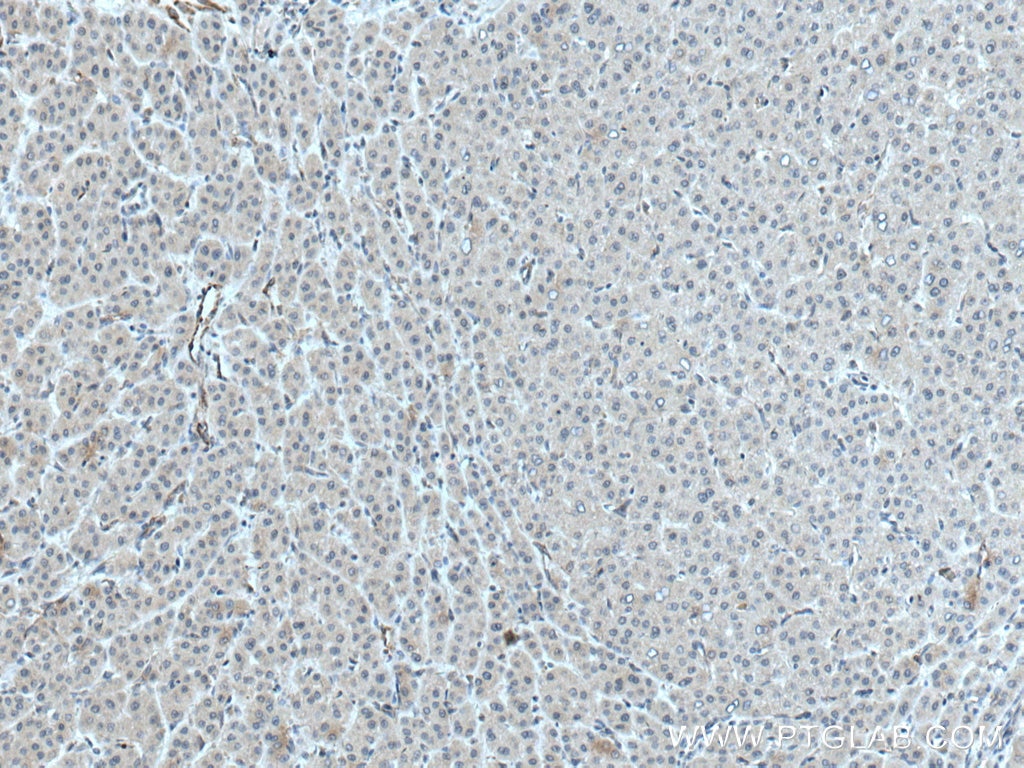 Immunohistochemistry (IHC) staining of human liver cancer tissue using ATG14/Barkor Polyclonal antibody (28021-1-AP)