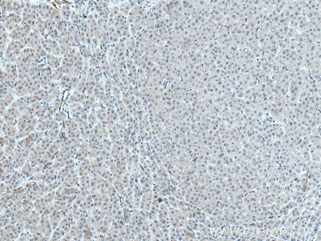 IHC staining of human liver cancer using 28021-1-AP