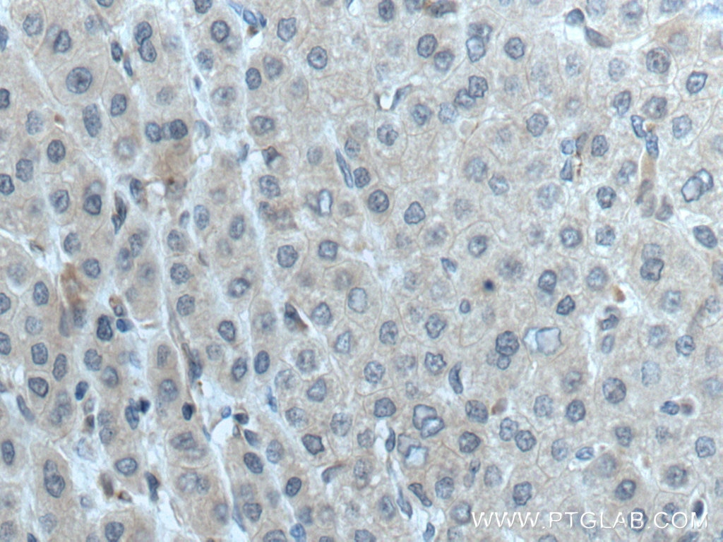 Immunohistochemistry (IHC) staining of human liver cancer tissue using ATG14/Barkor Polyclonal antibody (28021-1-AP)