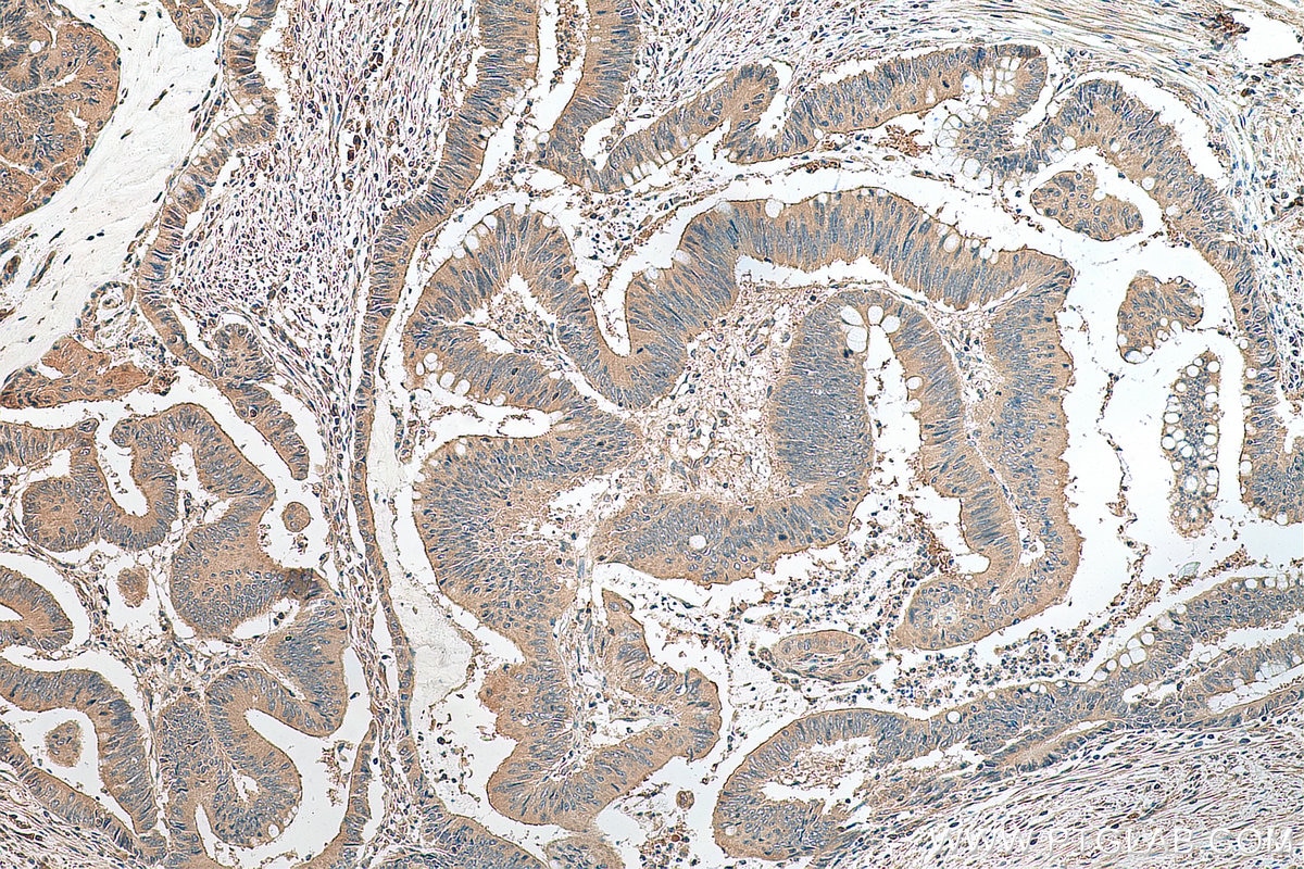 Immunohistochemistry (IHC) staining of human colon cancer tissue using ATG16L1 Polyclonal antibody (29445-1-AP)