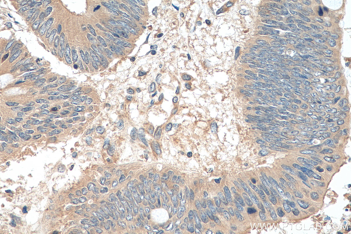 IHC staining of human colon cancer using 29445-1-AP