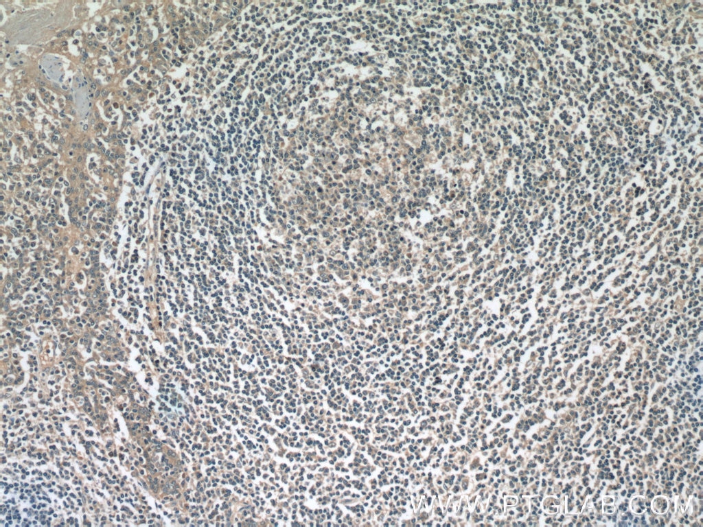 Immunohistochemistry (IHC) staining of human tonsillitis tissue using ATG2A Polyclonal antibody (23226-1-AP)