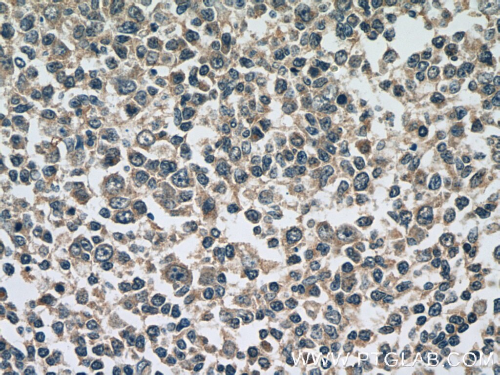 Immunohistochemistry (IHC) staining of human tonsillitis tissue using ATG2A Polyclonal antibody (23226-1-AP)