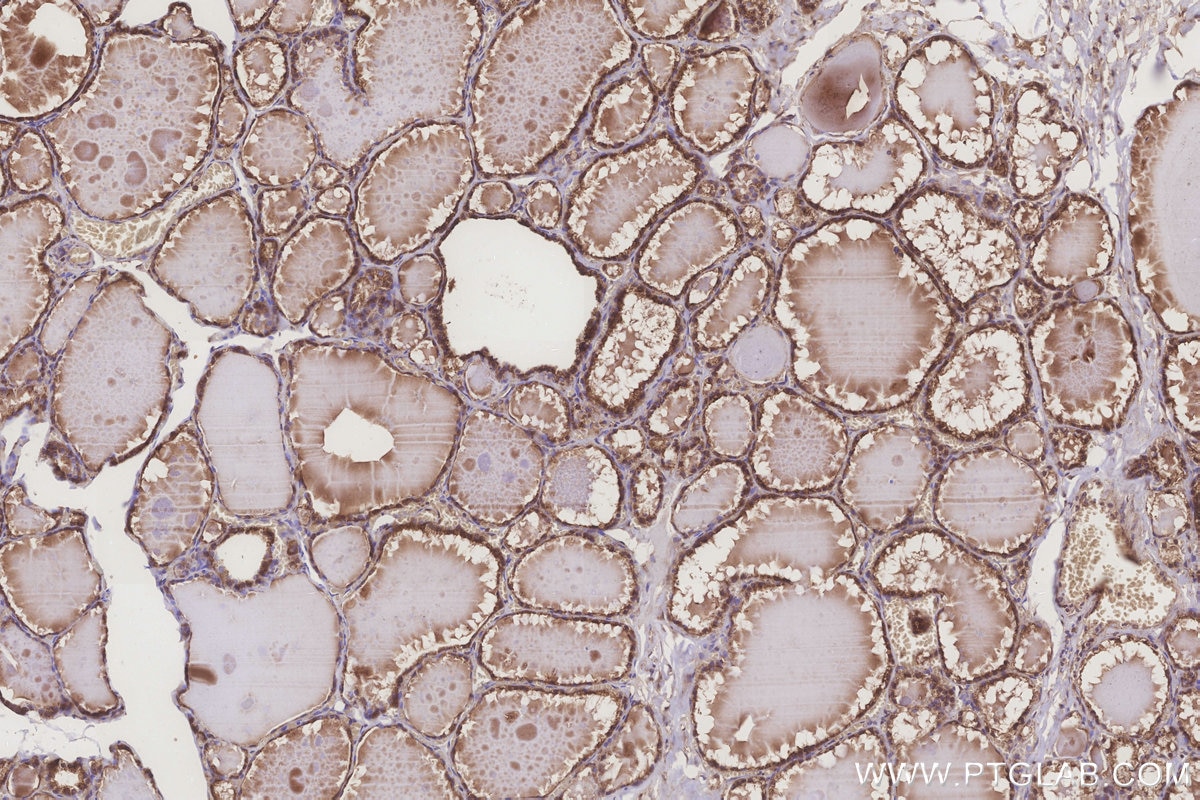Immunohistochemistry (IHC) staining of human thyroid cancer tissue using ATG2A Polyclonal antibody (23226-1-AP)