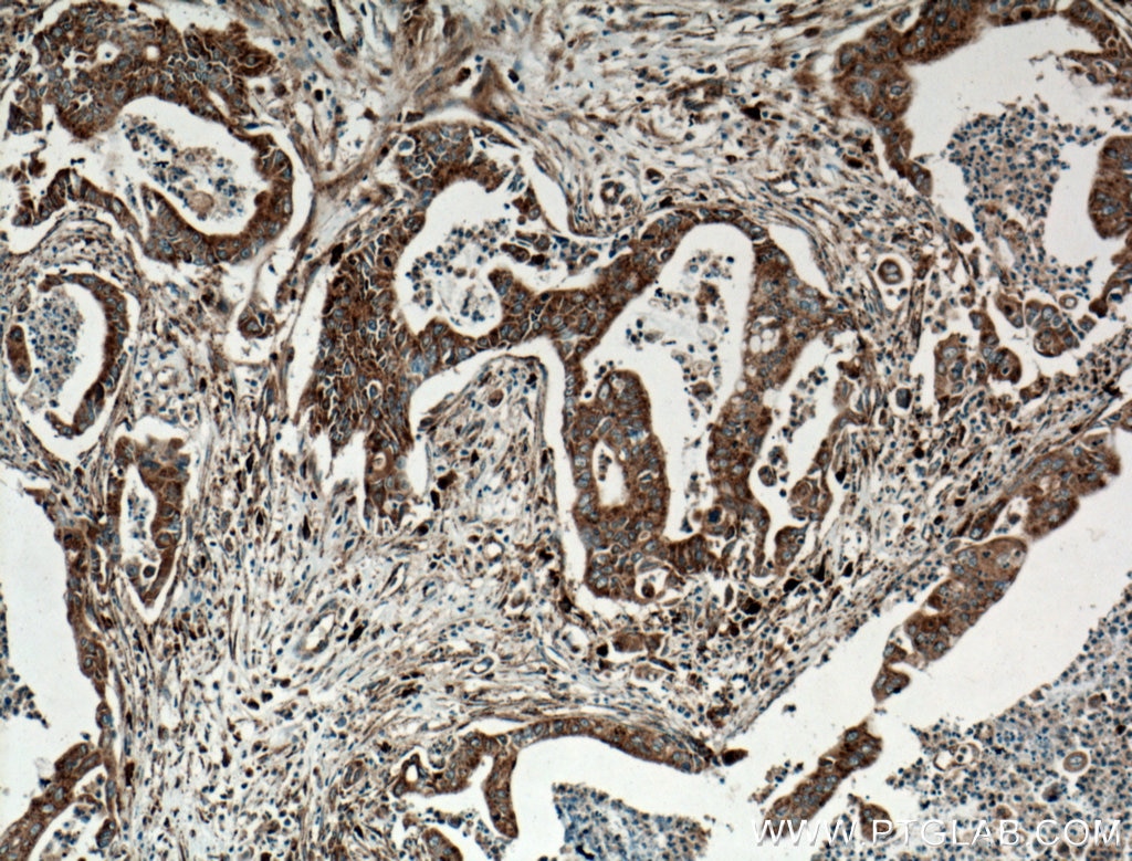 Immunohistochemistry (IHC) staining of human pancreas cancer tissue using ATG2B Polyclonal antibody (25155-1-AP)
