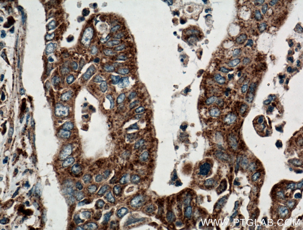 Immunohistochemistry (IHC) staining of human pancreas cancer tissue using ATG2B Polyclonal antibody (25155-1-AP)