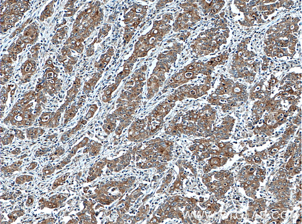 Immunohistochemistry (IHC) staining of human stomach cancer tissue using ATG4A Polyclonal antibody (27467-1-AP)
