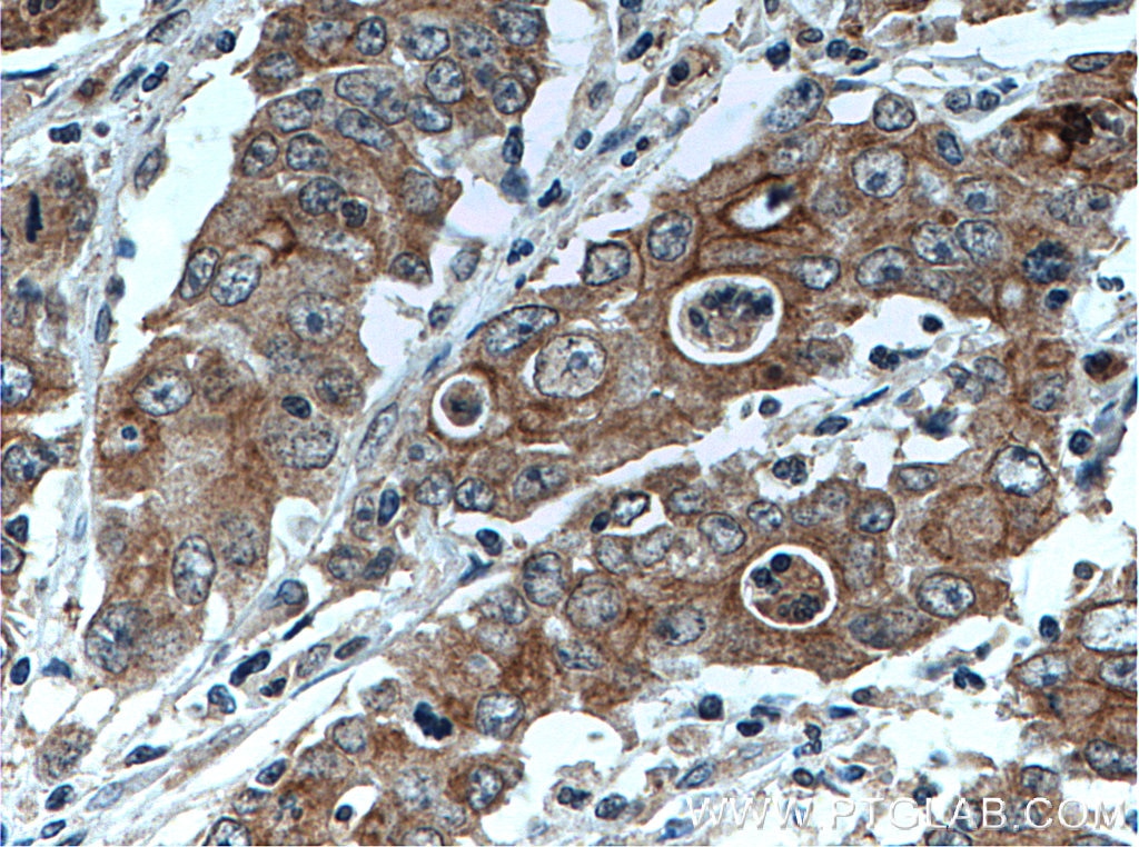 IHC staining of human stomach cancer using 27467-1-AP