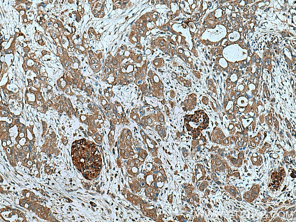 Immunohistochemistry (IHC) staining of human pancreas cancer tissue using ATG4B Polyclonal antibody (15131-1-AP)