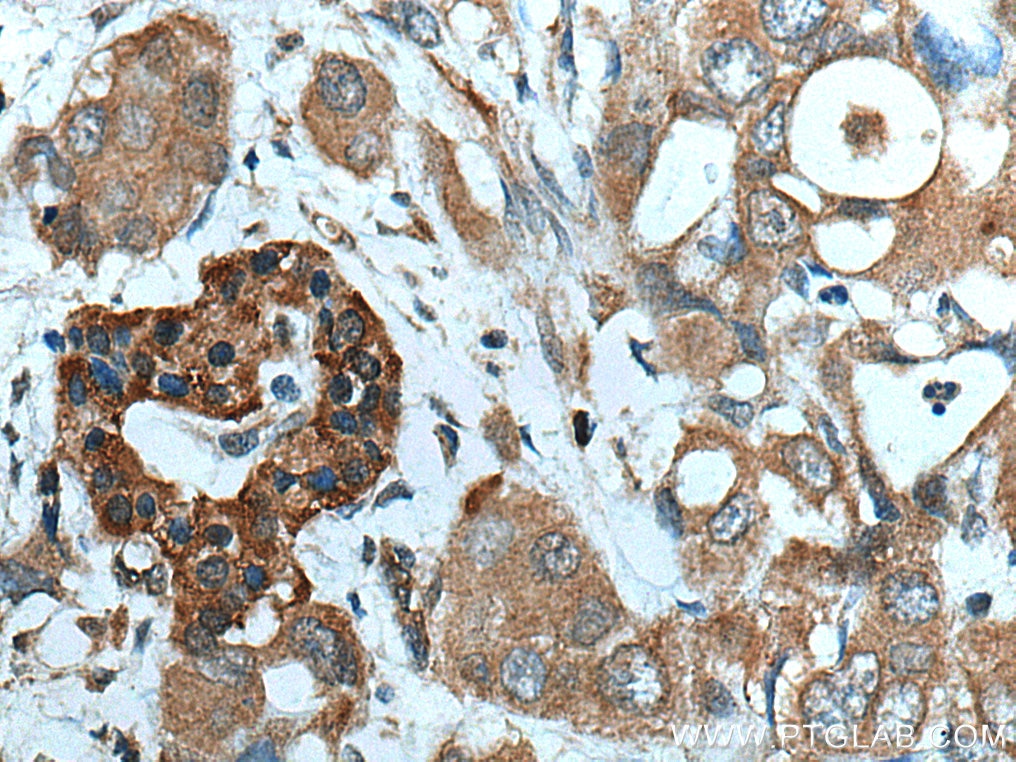 Immunohistochemistry (IHC) staining of human pancreas cancer tissue using ATG4B Polyclonal antibody (15131-1-AP)