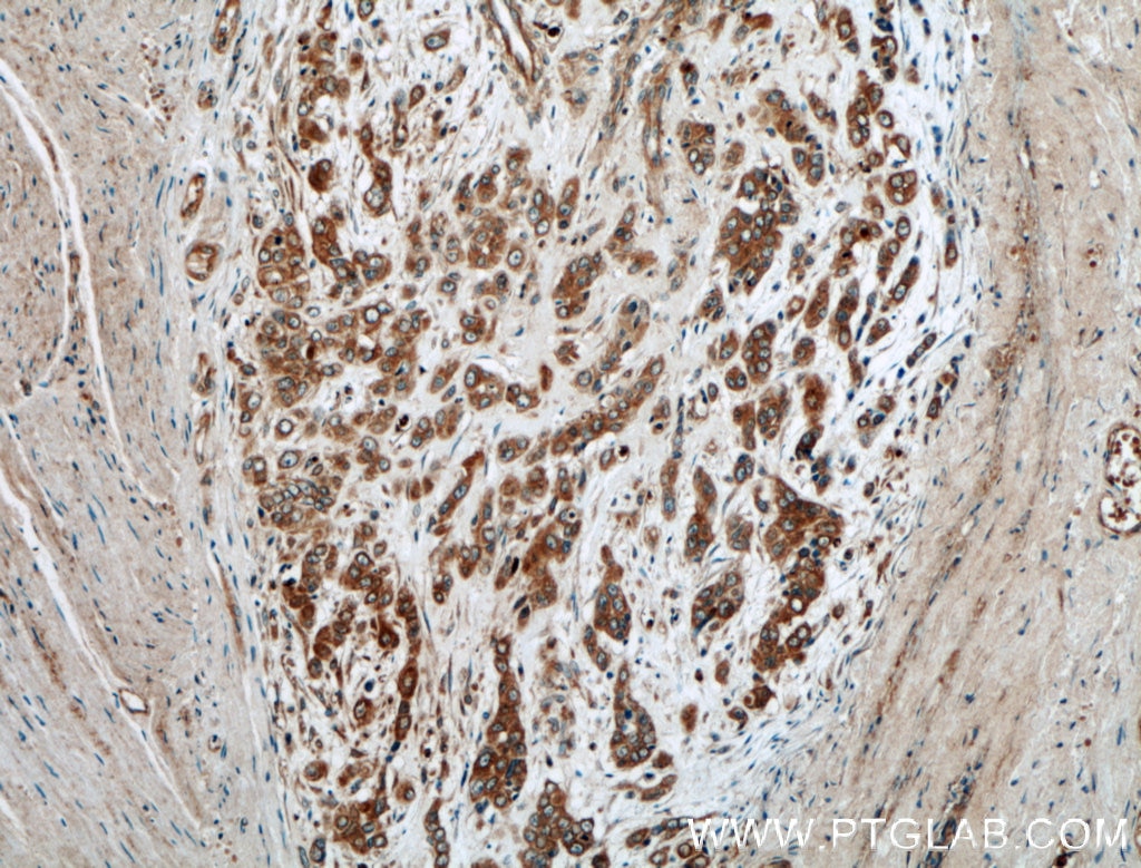 Immunohistochemistry (IHC) staining of human colon cancer tissue using ATG5 Polyclonal antibody (10181-2-AP)