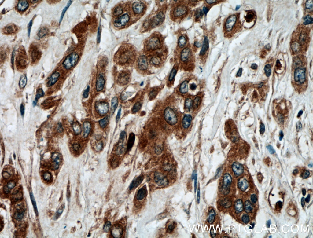 Immunohistochemistry (IHC) staining of human colon cancer tissue using ATG5 Polyclonal antibody (10181-2-AP)