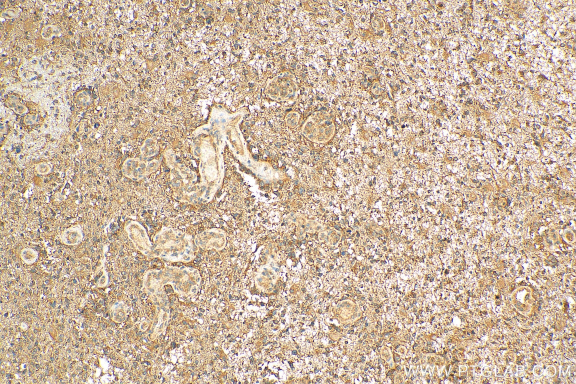 IHC staining of human gliomas using 10181-2-AP