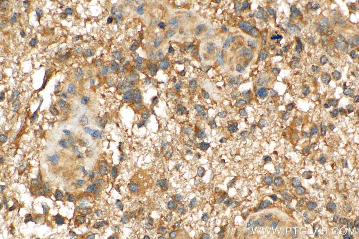 Immunohistochemistry (IHC) staining of human gliomas tissue using ATG5 Polyclonal antibody (10181-2-AP)