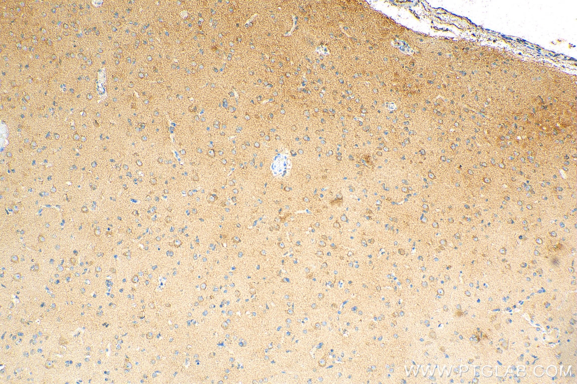 Immunohistochemistry (IHC) staining of human gliomas tissue using ATG5 Polyclonal antibody (10181-2-AP)