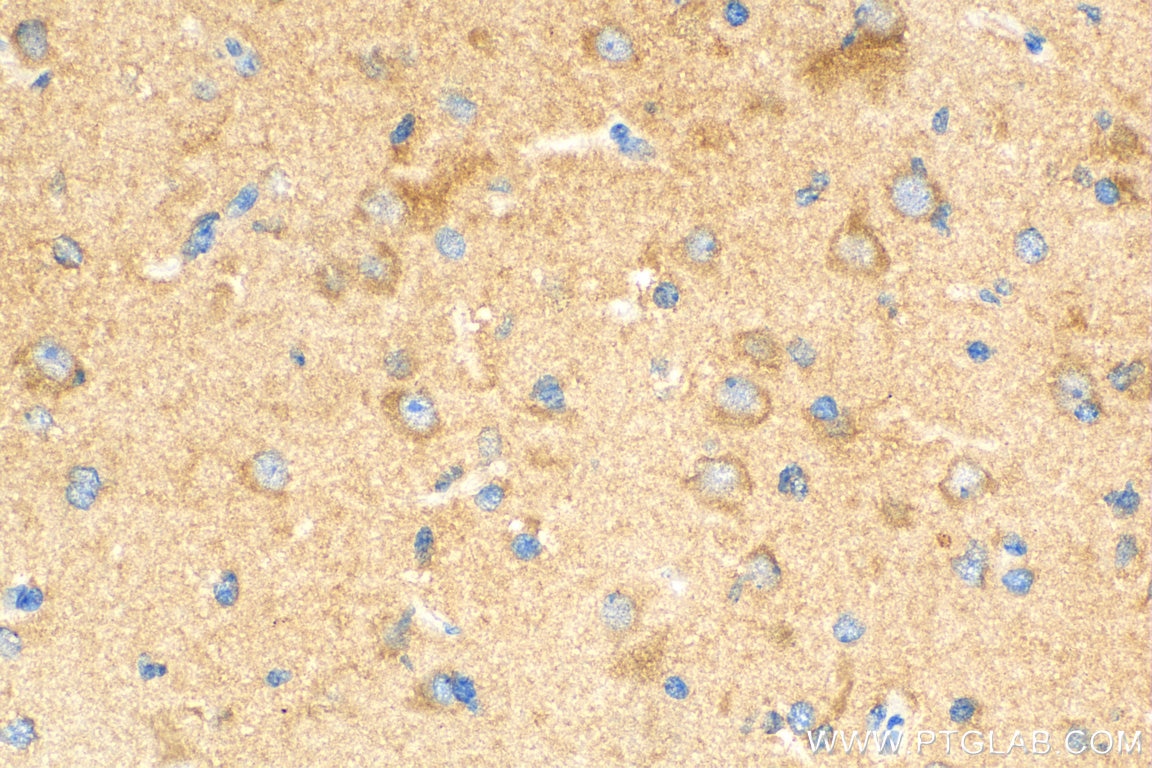 Immunohistochemistry (IHC) staining of human gliomas tissue using ATG5 Polyclonal antibody (10181-2-AP)