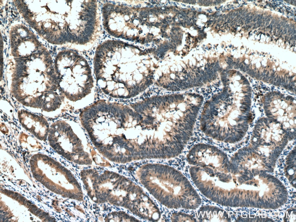 Immunohistochemistry (IHC) staining of human colon cancer tissue using ATG5 Monoclonal antibody (60061-1-Ig)