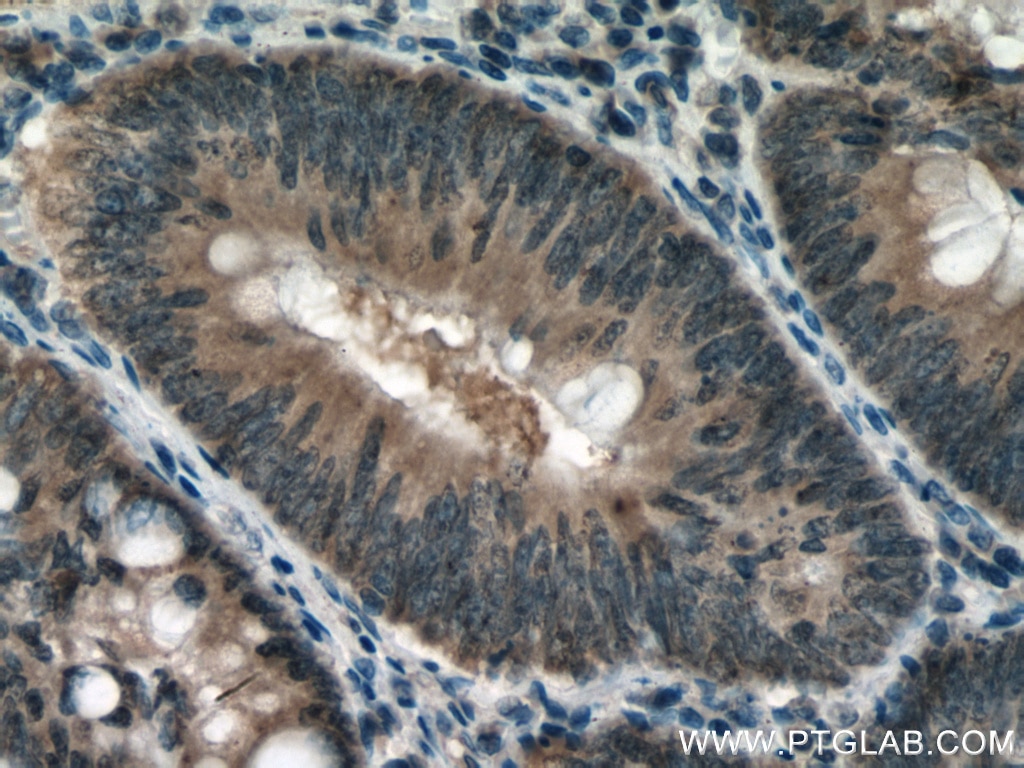 Immunohistochemistry (IHC) staining of human colon cancer tissue using ATG5 Monoclonal antibody (60061-1-Ig)