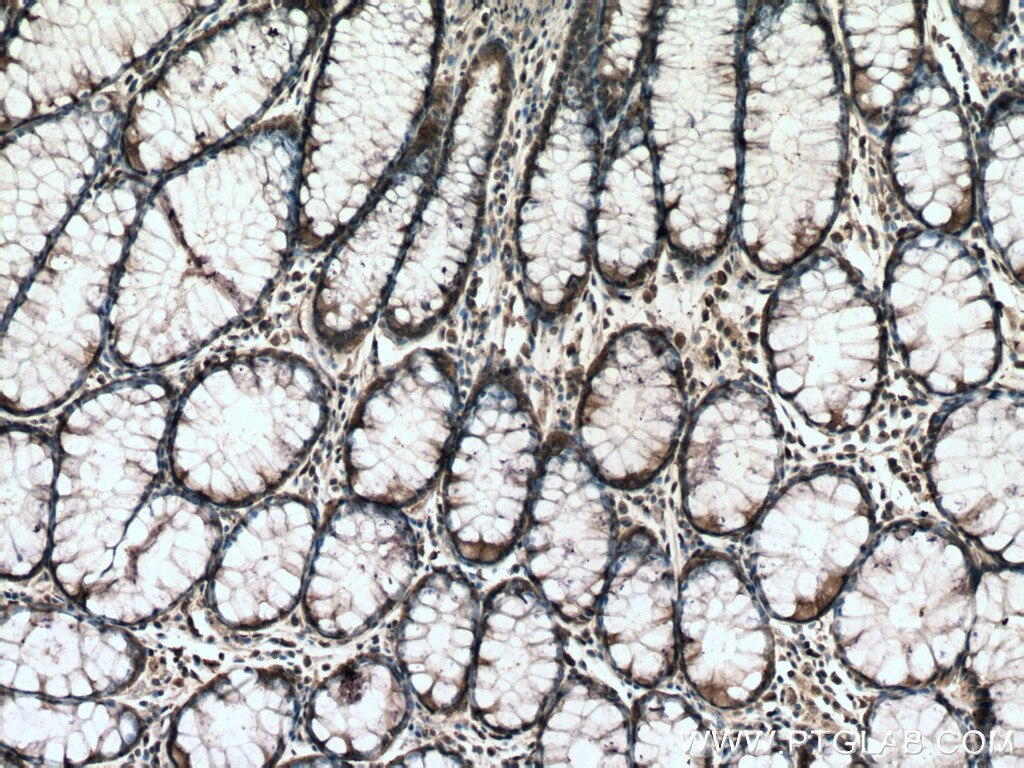 IHC staining of human colon cancer using 60061-1-Ig