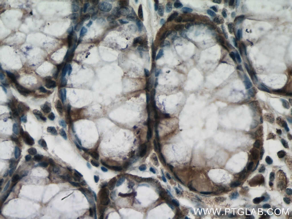 Immunohistochemistry (IHC) staining of human colon cancer tissue using ATG5 Monoclonal antibody (60061-1-Ig)