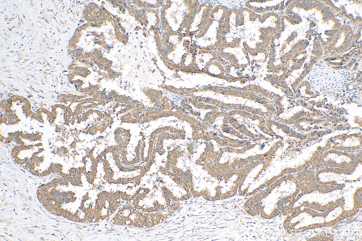 Immunohistochemistry (IHC) staining of human ovary tumor tissue using ATG5 Recombinant antibody (81803-1-RR)