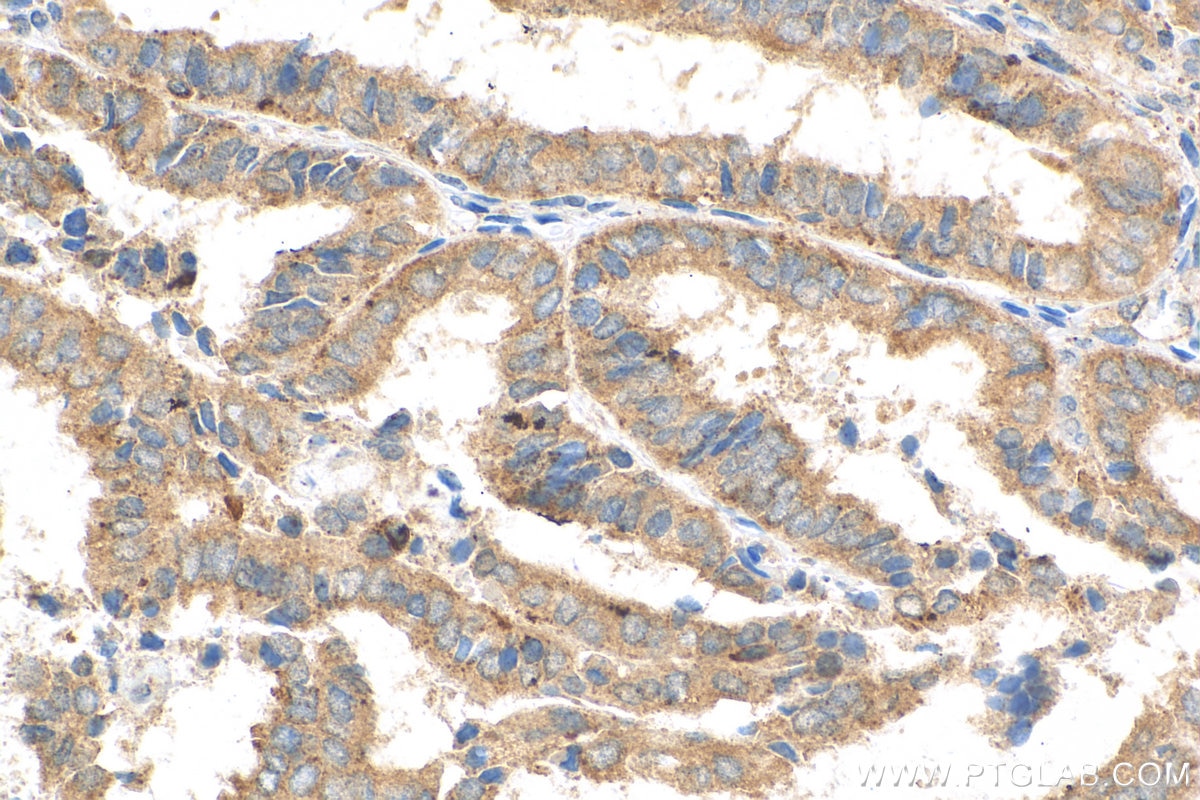 IHC staining of human ovary tumor using 81803-1-RR