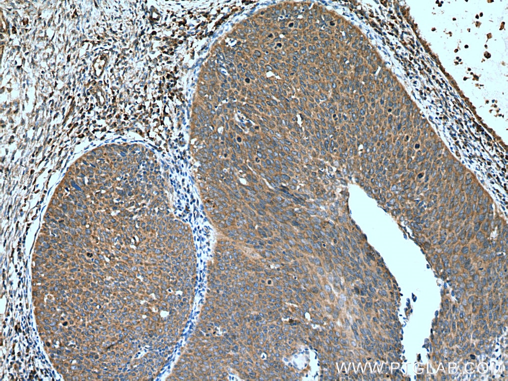 Immunohistochemistry (IHC) staining of human cervical cancer tissue using ATG7 Polyclonal antibody (10088-2-AP)