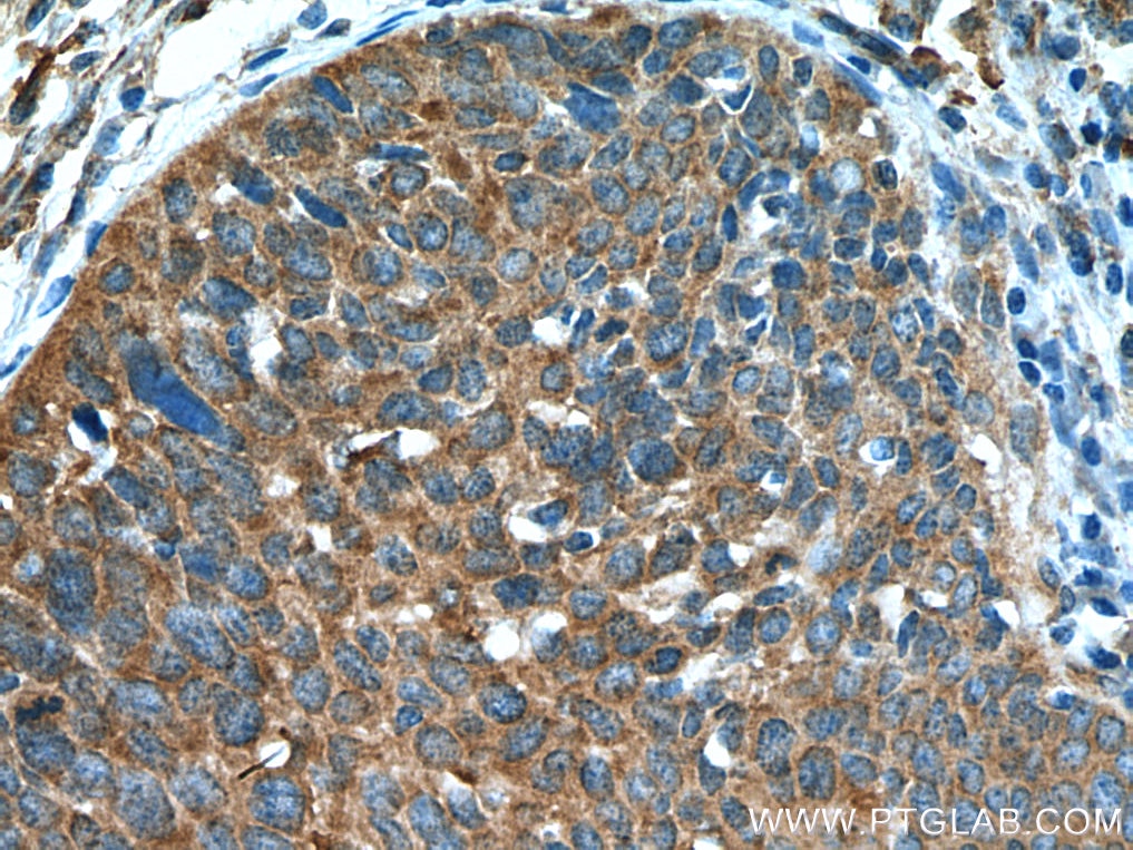 Immunohistochemistry (IHC) staining of human cervical cancer tissue using ATG7 Polyclonal antibody (10088-2-AP)
